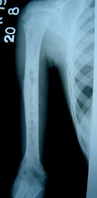 Post Operative X-Ray